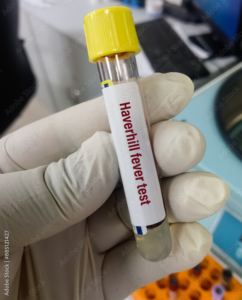 Haverhill fever (epidemic arthritic erythema) is a systemic illness caused by the bacterium Streptobacillus moniliformis, Rat bite fever Haverhill fever (epidemic arthritic erythema) is a systemic illness caused by the bacterium Streptobacillus moniliformis, Rat bite fever