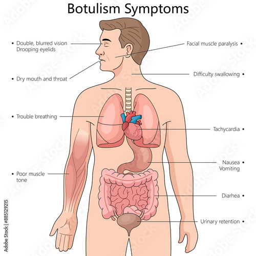 symptoms of botulism including vision issues, muscle paralysis, difficulty swallowing, respiratory problems diagram hand drawn schematic raster illustration. Medical science educational illustration