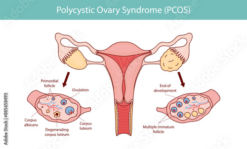 Polycystic ovary syndrome PCOS.  Ovarian cysts of the female reproductive system. New Year illustration is hand drawn.