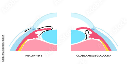 Glaucoma eye disease
