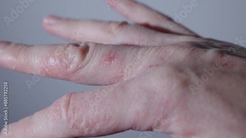 Palm hand exhibits redness bright sign of psoriasis close-up. Dermatology psoriasis inflammation irritation on dry skin illness sickness Dermatology psoriasis meticulously examined affected area