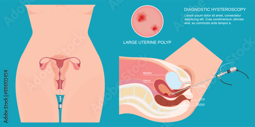 Diagnostic hysteroscopy is a minimally invasive procedure called a hysteroscope.