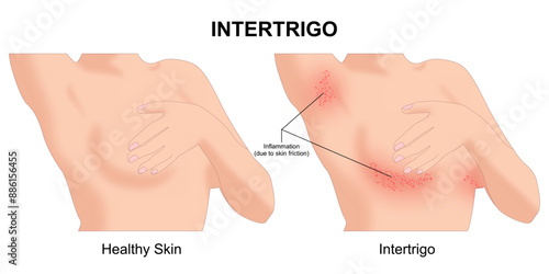 Intertrigo skin inflammation, rashes, redness, underarms, etc.