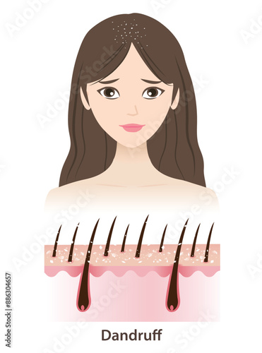 The woman with dandruff on hair vector illustration isolated on white background. Cross section of white dry flakes, scaly patches on scalp layer. Hair care and problem concept.