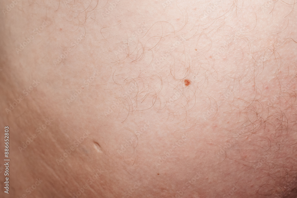 skin with moles and scars
skin with moles and scars