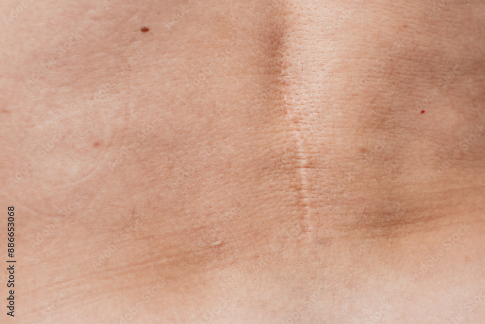 Fototapeta premium scar on the back after surgery for herniated disc 
