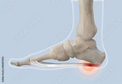 Plantar Fasciitis Anatomy Medical Illustration