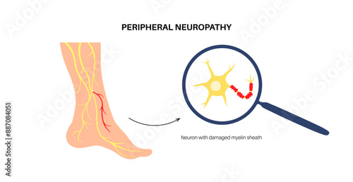 Peripheral neuropathy medical poster