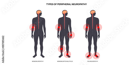 Peripheral neuropathy medical poster