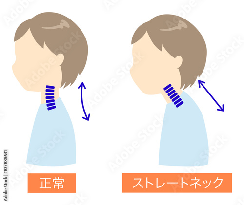 正常とストレートネックの人物の比較イラスト