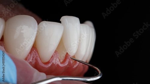 a beautiful moment of trying on a ceramic veneer on the lower jaw using a dental probe
