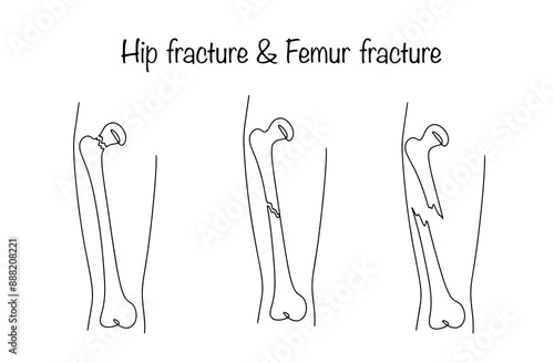 Hip fracture