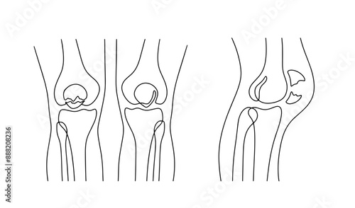 Patella fracture
