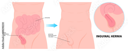 Umbilical hernia and intestine protrudes through abdominal muscles with stomach pain