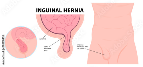 Stomach abdominal pain of large intestine constipation with belly button umbilical hernia or small inguinal incisional Femoral around navel lump