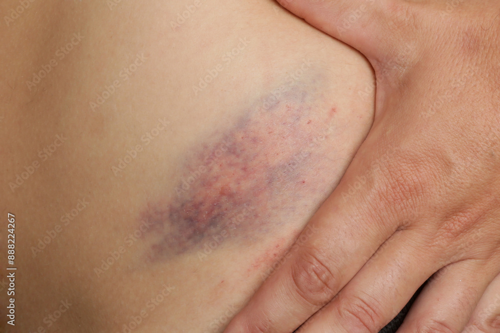 Fototapeta premium Close up view of a nasty bruise