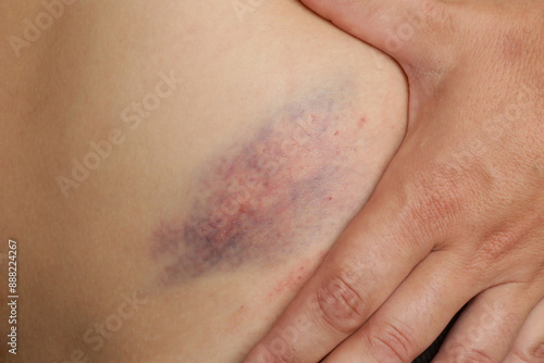 Close up view of a nasty bruise
