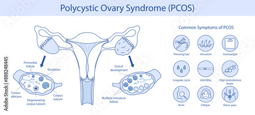 Polycystic ovary syndrome PCOS.  Ovarian cysts of the female reproductive system. New Year illustration is hand drawn.