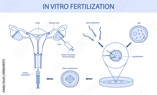 In vitro fertilization diagram drawn in cartoon style.