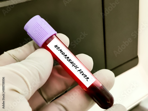 Biological specimen (blood) in vacuum tube for pathological analysis. Medical laboratory various testing concept. health care conceptional images photo