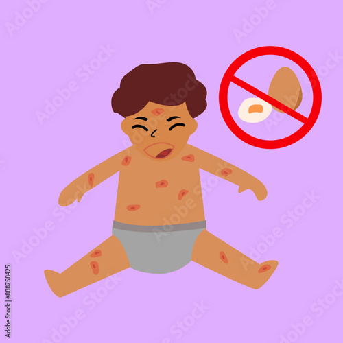 Egg allergy in children Skin with red rashes, hives