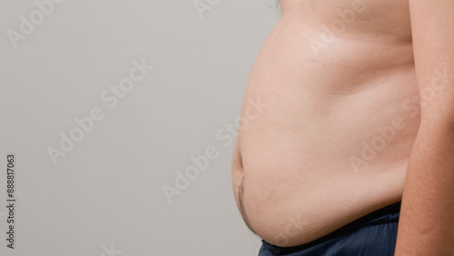 Wallpaper Mural Fat man with a big belly worries about his body. Fat man has excess fat on a white background. Concept of unhealthy body need to figure out. Men at risk for diabetes Belly fat. Obesity concept. Torontodigital.ca