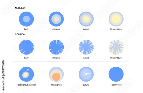 Cataract eye disease