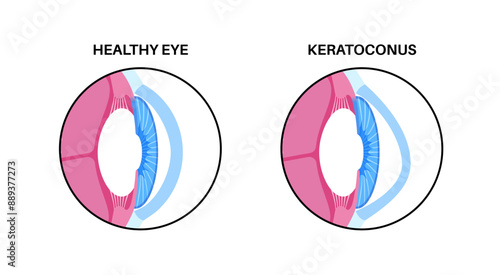 Cataract eye disease
