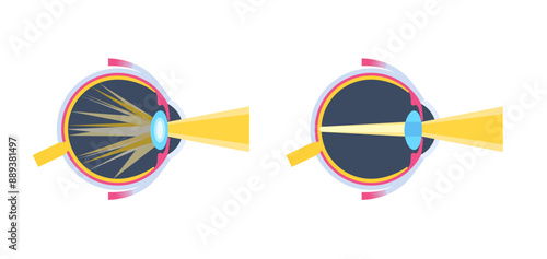 Cataract eye disease
