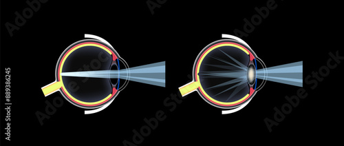 Cataract eye disease
