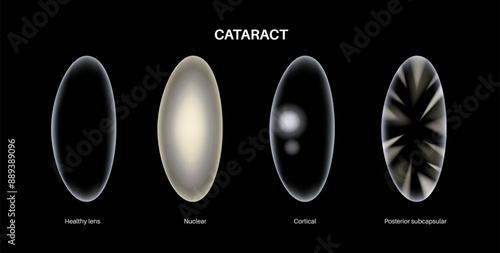 Cataract eye disease