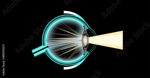 Cataract eye disease