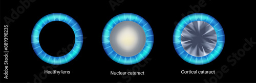 Cataract eye disease