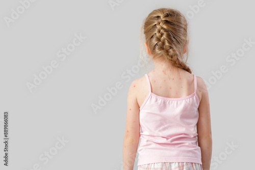 Obraz na plátně Little girl ill with chickenpox on light background, back view