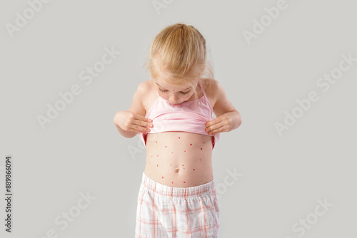 Little girl ill with chicke...