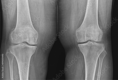 Canvas Print Knee X-ray of Femur Tibia Fibula and Patella
