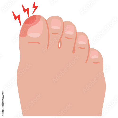 Vector swollen toe onychocryptosis cartoon foot with nail disease illustration
