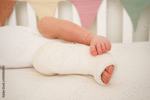 Newborn little baby with leg in a cast - clubfoot, close-up.