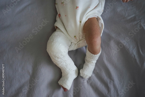 Top view newborn little baby with leg in a cast - clubfoot.