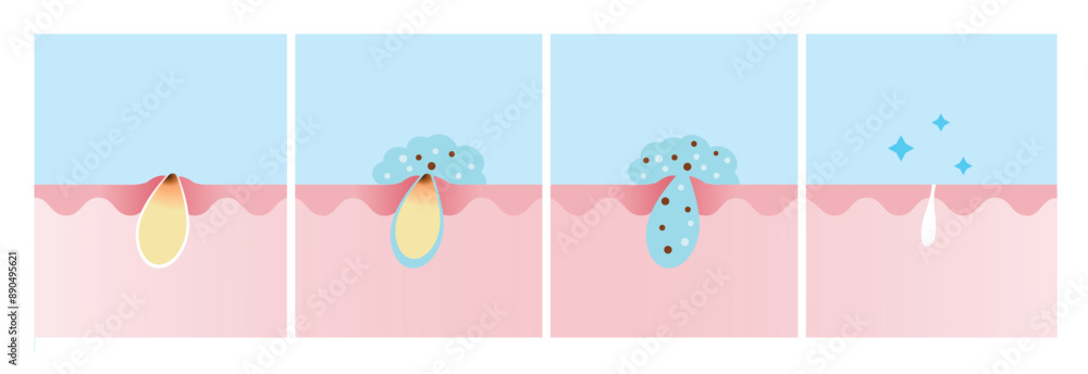 Step of acne pimple treatment process vector illustration. Apply salicylic acid on skin layer, penetrate into skin to dissolve the dead skin cells clogging pore and decrease redness and swelling. Step of acne pimple treatment process vector illustration. Apply salicylic acid on skin layer, penetrate into skin to dissolve the dead skin cells clogging pore and decrease redness and swelling.