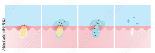 Step of acne pimple treatment process vector illustration. Apply salicylic acid on skin layer, penetrate into skin to dissolve the dead skin cells clogging pore and decrease redness and swelling.