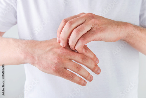 Photos Man scratches or shows hands with dry, cracked skin on white backgrounds