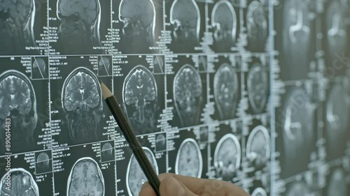 Doctor holding pencil and pointing to brain scans