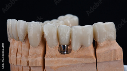 Принти на полотні dental crowns made of zircon on a model of the lower jaw on a black background