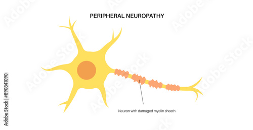 Peripheral neuropathy medical poster
