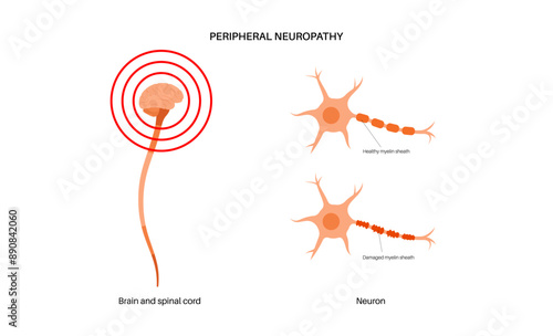 Peripheral neuropathy medical poster photo