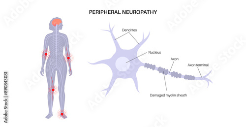 Peripheral neuropathy medical poster