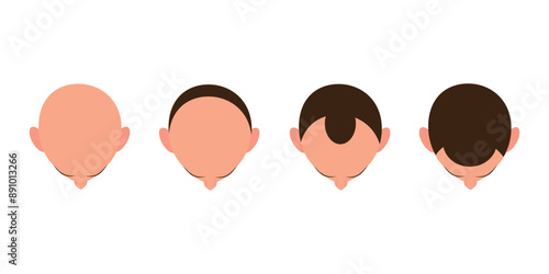 Hair loss bald head alopecia transplant growth vector top view. Hair loss men top view alopecia scalp problem