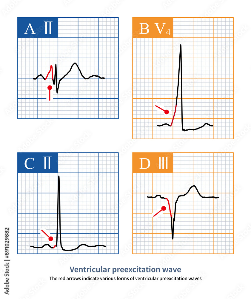 Ventricular preexcitation is the pre excitation of a portion of the ventricular muscle by the accessory pathway, forming a rough and dull, and fuzzy δ wave that can be positive, negative, or biphasic. Ventricular preexcitation is the pre excitation of a portion of the ventricular muscle by the accessory pathway, forming a rough and dull, and fuzzy δ wave that can be positive, negative, or biphasic.