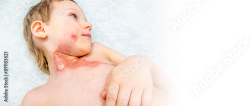 medical procedure dressing a boy with a first-degree burn from boiling water on his face, neck and chest